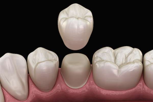 What To Ask Your General Dentist When Preparing for a Crown from Austin Lakes Dentistry: Scott T Gordon DDS in Austin, TX