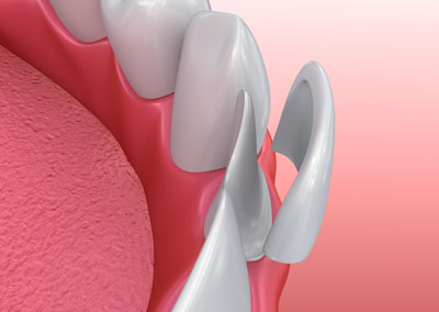 Veneers Dentist