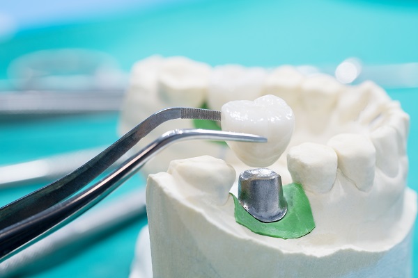 Dental Crowns Austin, TX