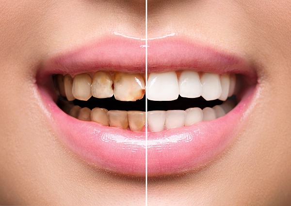 Questions To Ask When Considering A Smile Makeover