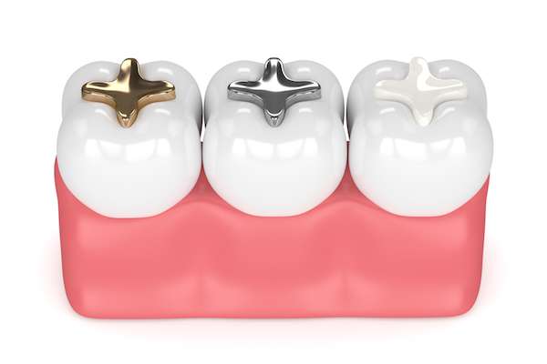 A General Dentist Discusses Different Filling Options from Austin Lakes Dentistry: Scott T Gordon DDS in Austin, TX