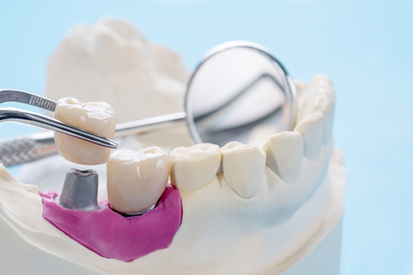 Dental Crowns Austin, TX