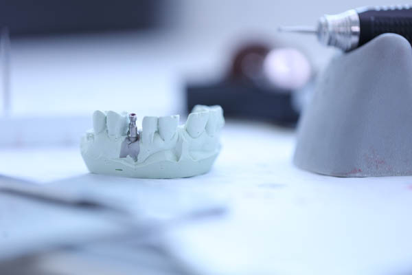 Implant Restoration Austin, TX