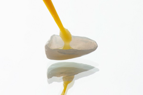 How Long Will Dental Bonding Last?