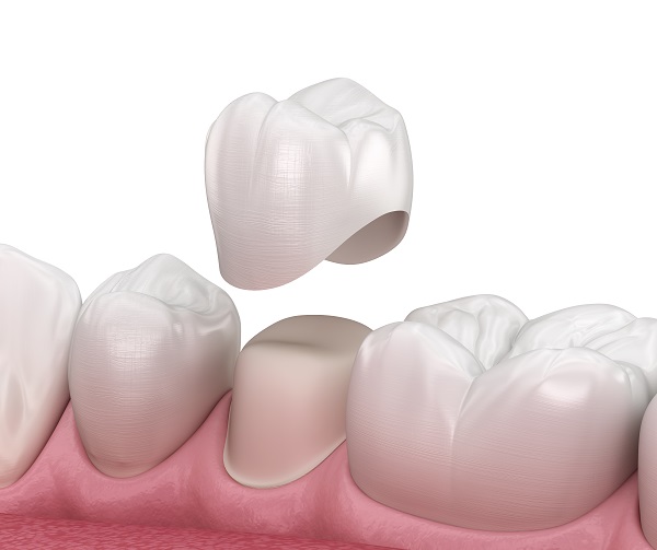 Options For Dental Crowns Material