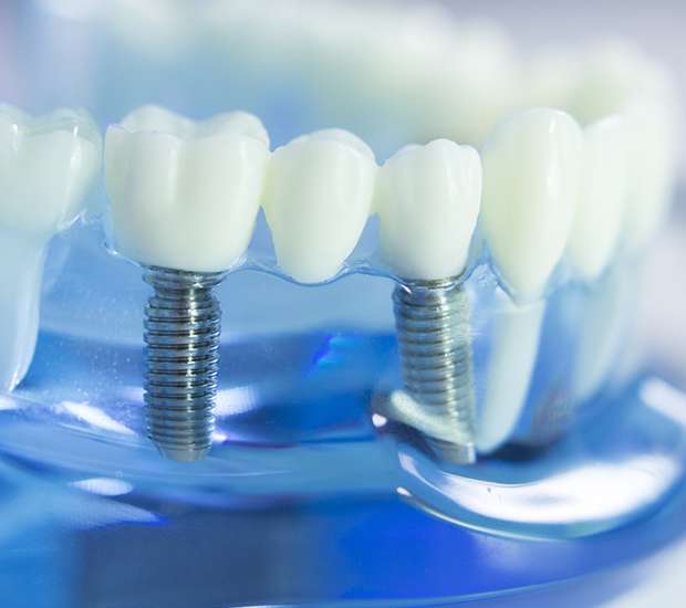 Austin Dental Implants