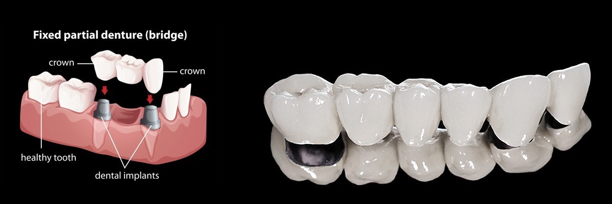 Austin Dentures