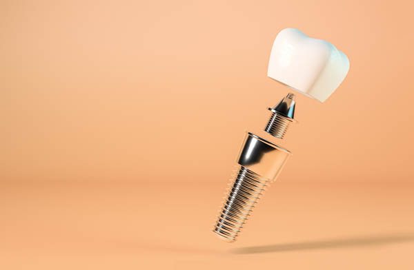 Implant Dentist Austin, TX