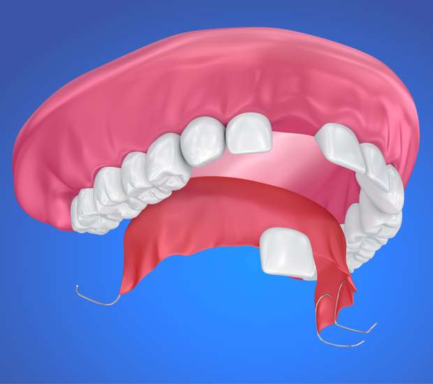 Austin Partial Denture for One Missing Tooth
