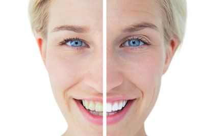 Why Teeth Whitening Products Make Teeth Appear Brighter