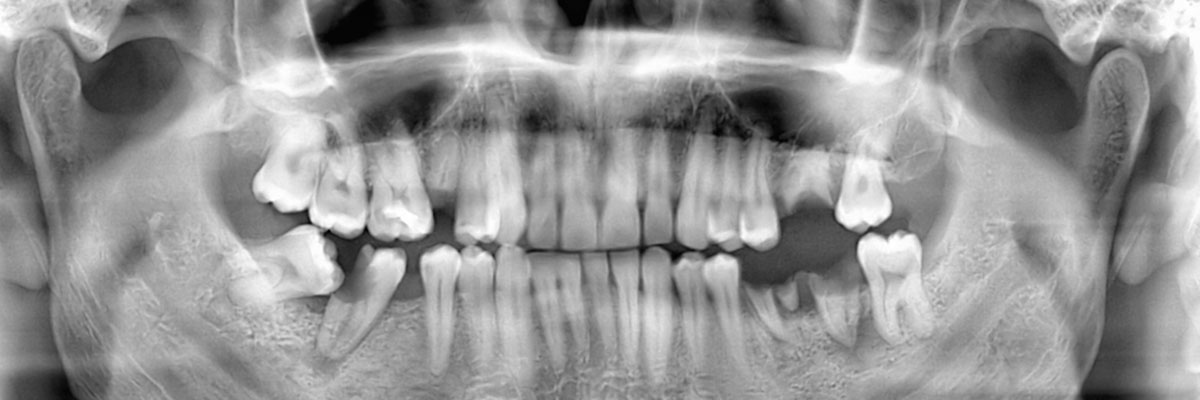 Austin Wisdom Teeth Extraction